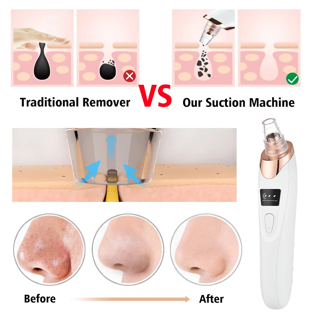 Facial Blackhead Remover Electric Pore Cleaner