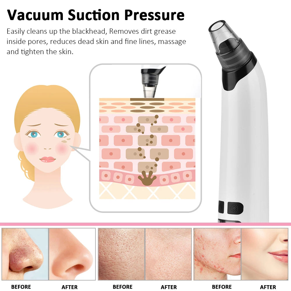 Blackhead Remover Face Deep Vacuum Suction